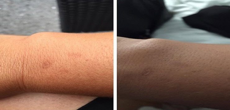 apple watch cilt yanigi